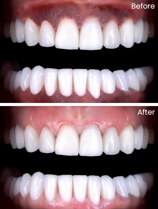 Periodontal Depigmentation - Before & After