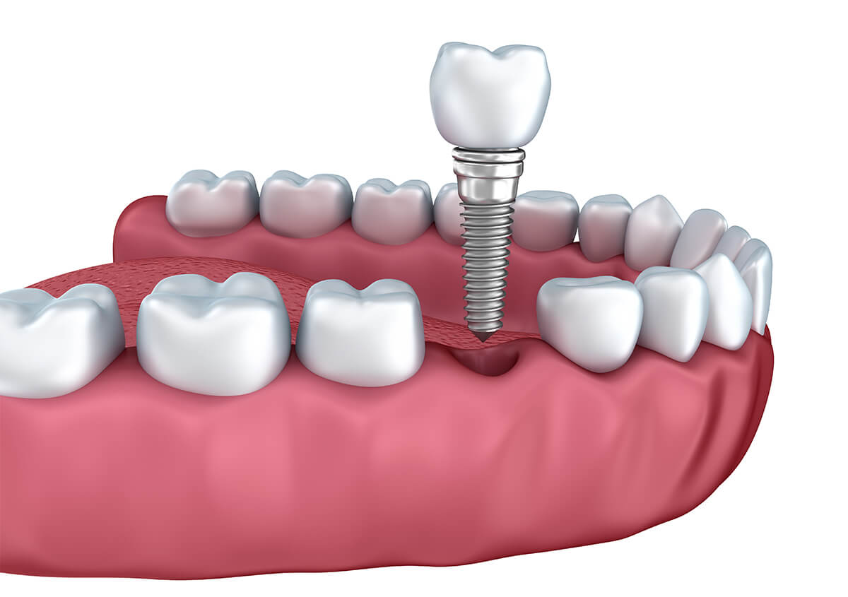 Can You Replace All Your Teeth With Implants in Winnipeg MB Area